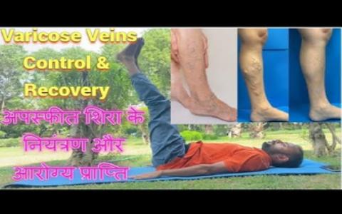 How to control Varicose Veins & Recovery